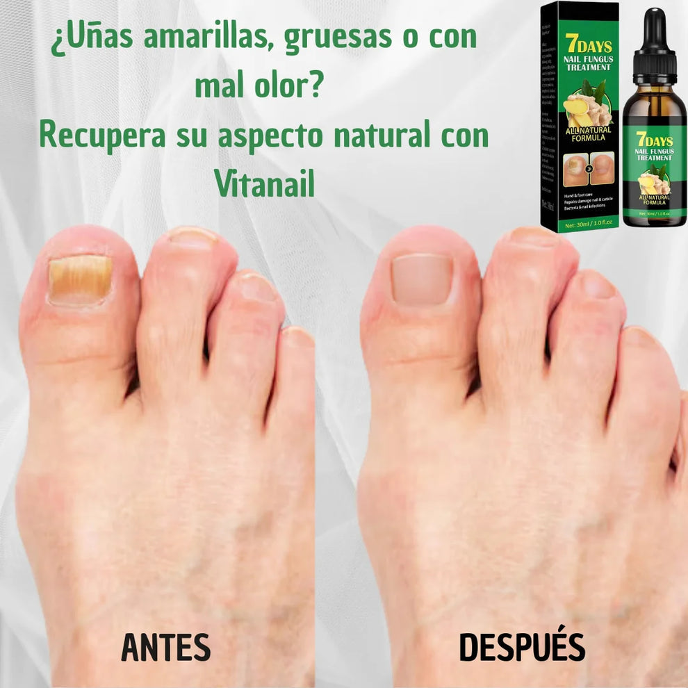 PurNail® - Aceite antihongos uñas