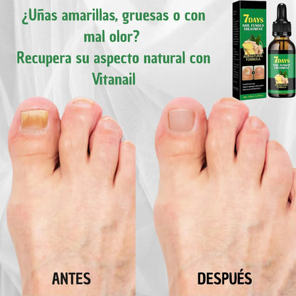 PurNail® - Aceite antihongos uñas